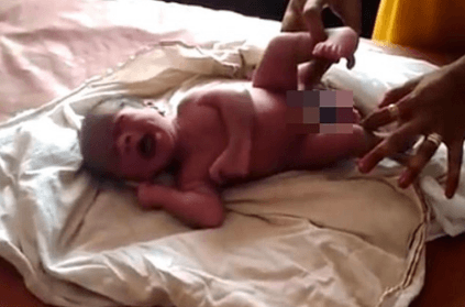 baby born with four legs and two penises in Uttar Pradesh