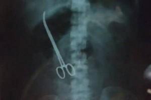 Shocking - Doctors leave behind forceps in woman's abdomen; Found after 3 months Shocking - Doctors leave behind forceps in woman's abdomen; Found after 3 months