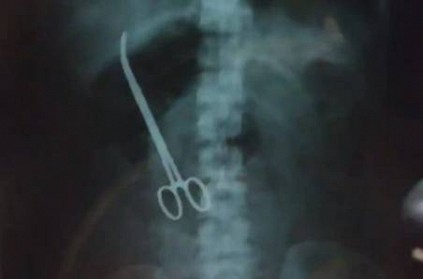 Hyderabad - Doctors leave behind forceps in womans abdomen Hyderabad - Doctors leave behind forceps in womans abdomen