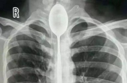 20-cm-long spoon which was stuck in man’s throat for more than a year