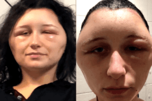 19-Year-Old Left With A Swollen Head After Suffering Allergic Reaction To Hair Dye